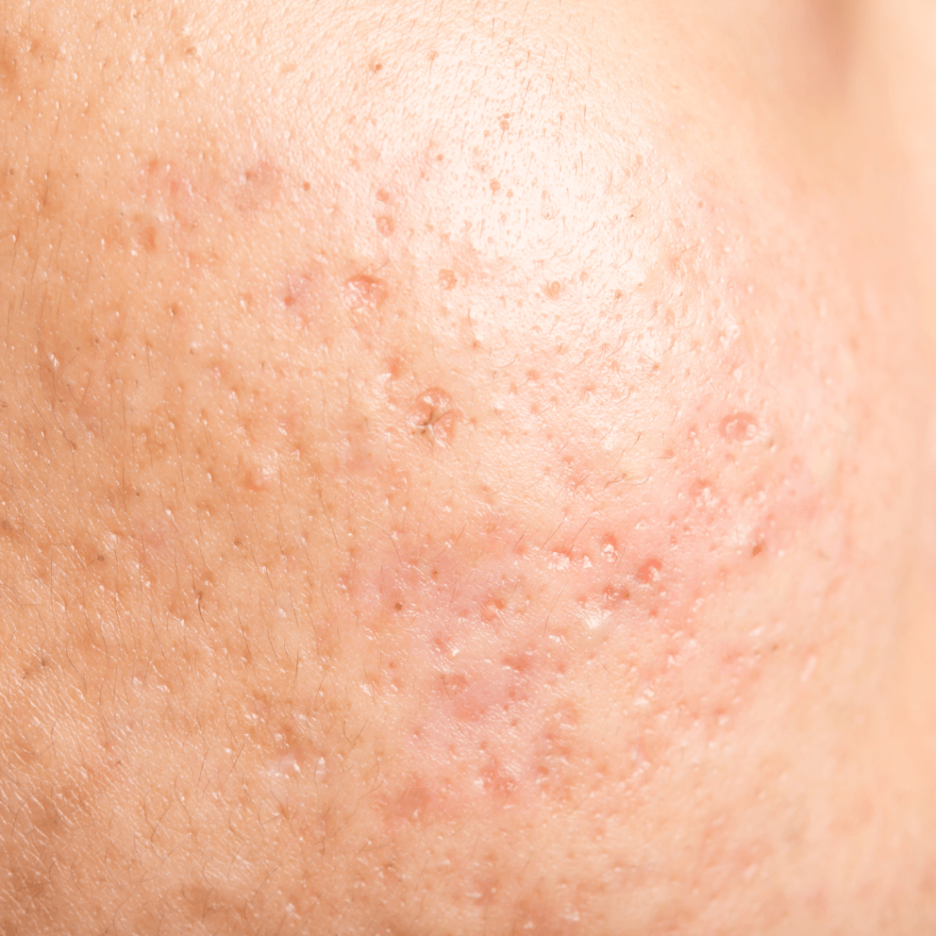 ožiljci od akni na koži lica