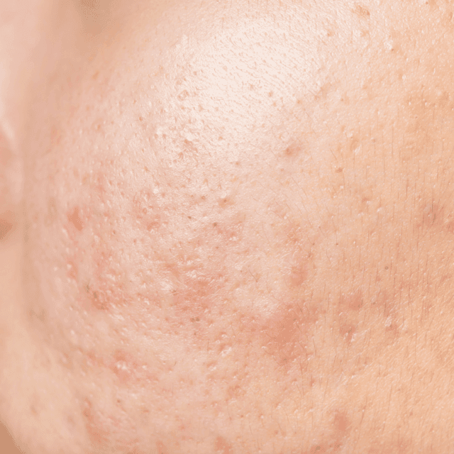 ožiljci od akni na koži lica - lečenje ovakvih ožiljaka od akni moguće je uz PRP