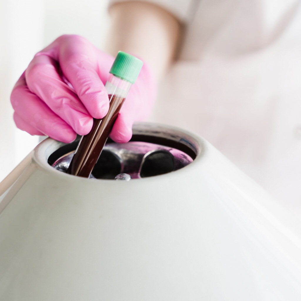 plazma bogata trombocitima - epruveta PRP-a spremna za upotrebu