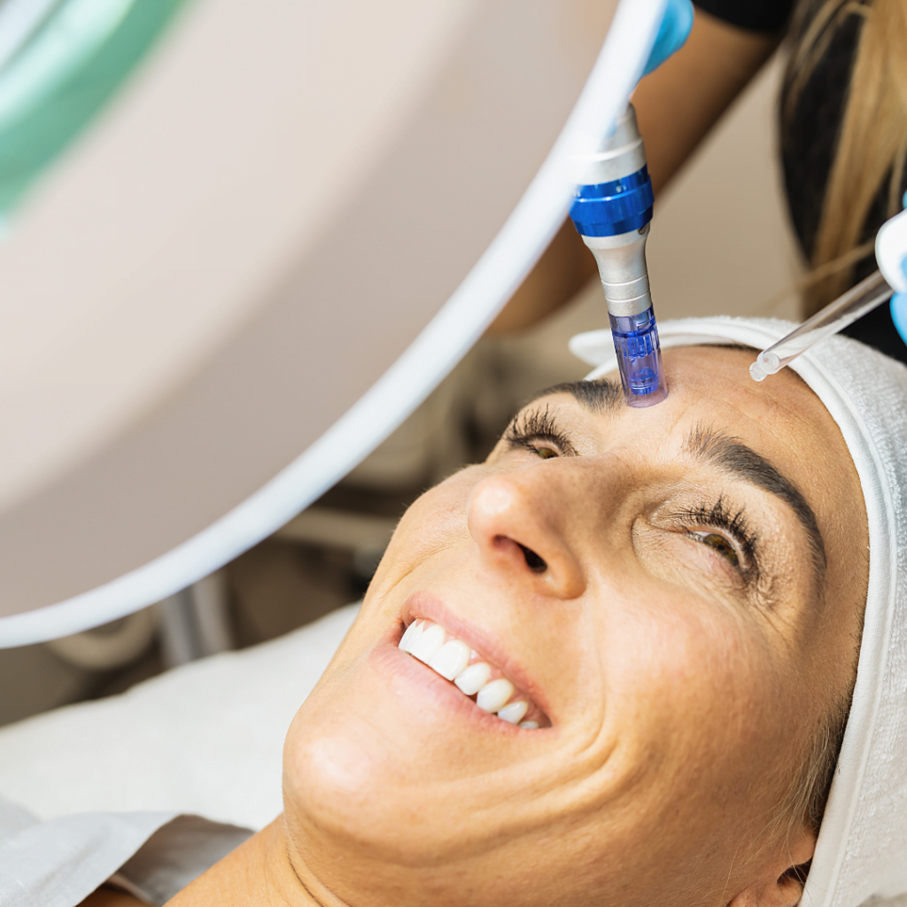 prp tretman za lečenje ožiljaka od akni - pacijentkinja leži nasmejana, dok lekar aplicira plazbu bogatu trombocitima u njeno čelo. nasmejana je jer je tretman bezbolan.