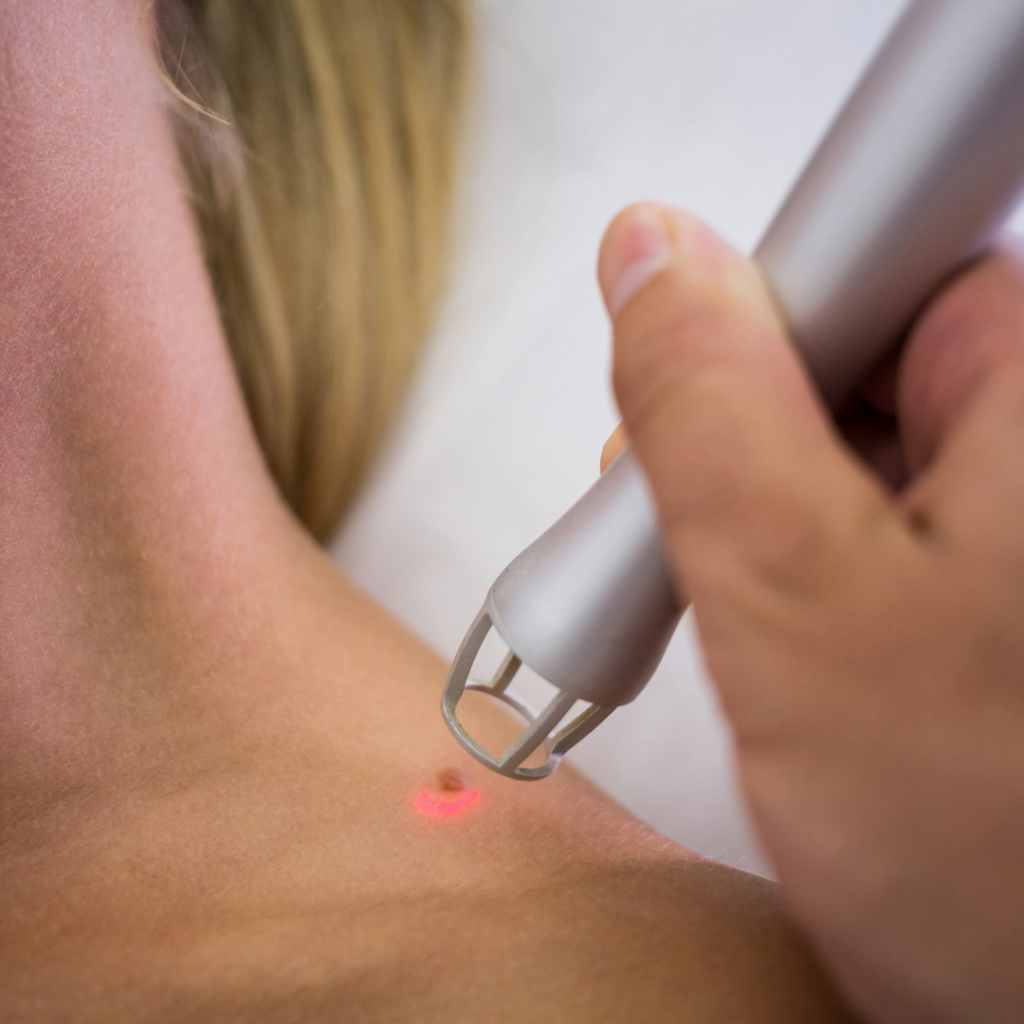 uklanjanje benignih promena na koži - uklanjanje mladeža radiotalasima