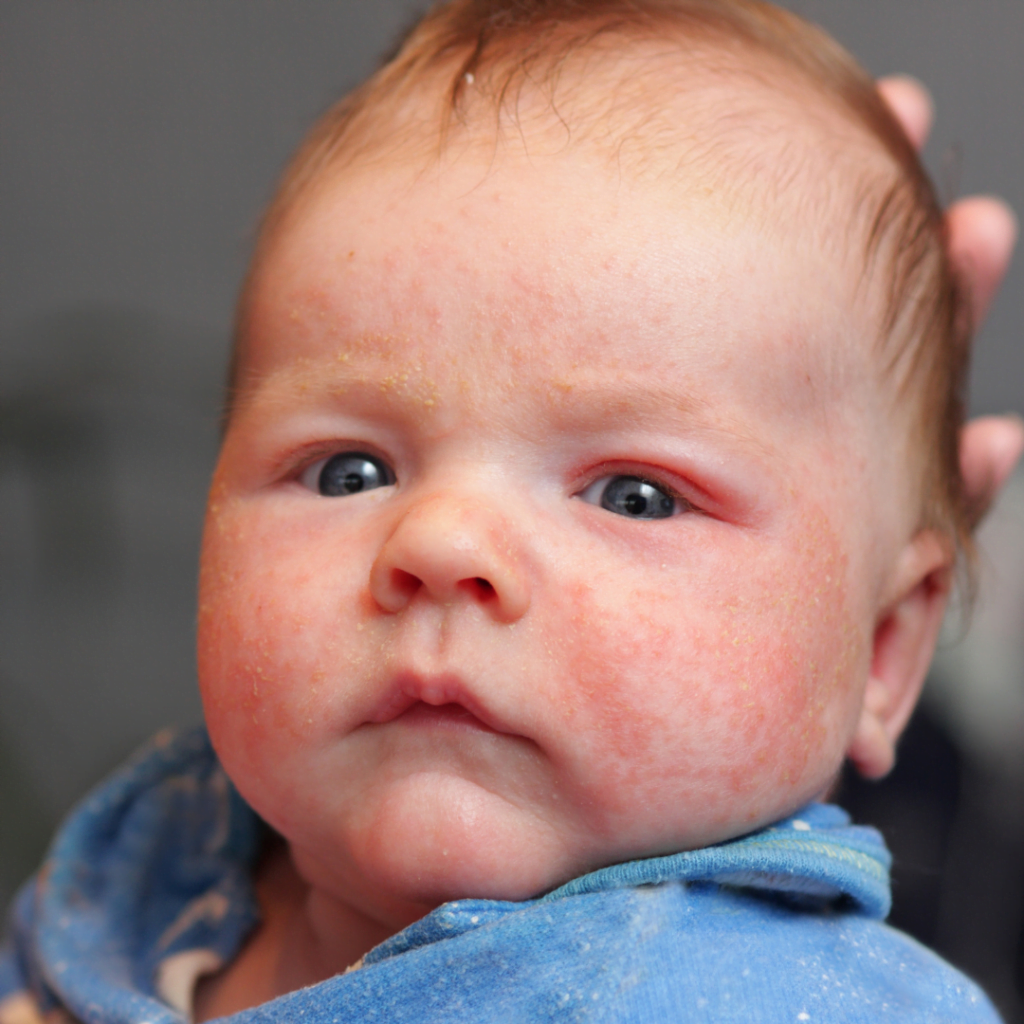 ekcem kod dece izaziva crvenilo na koži. na slici je plavooka beba sa crvenilom na licu usled ekcema