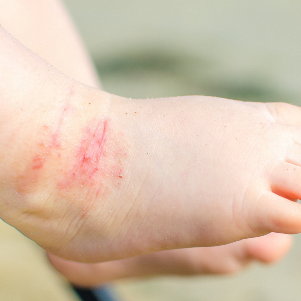 dečije stopalo zahvaćeno ekcemom (atopiskim dermatitisom)