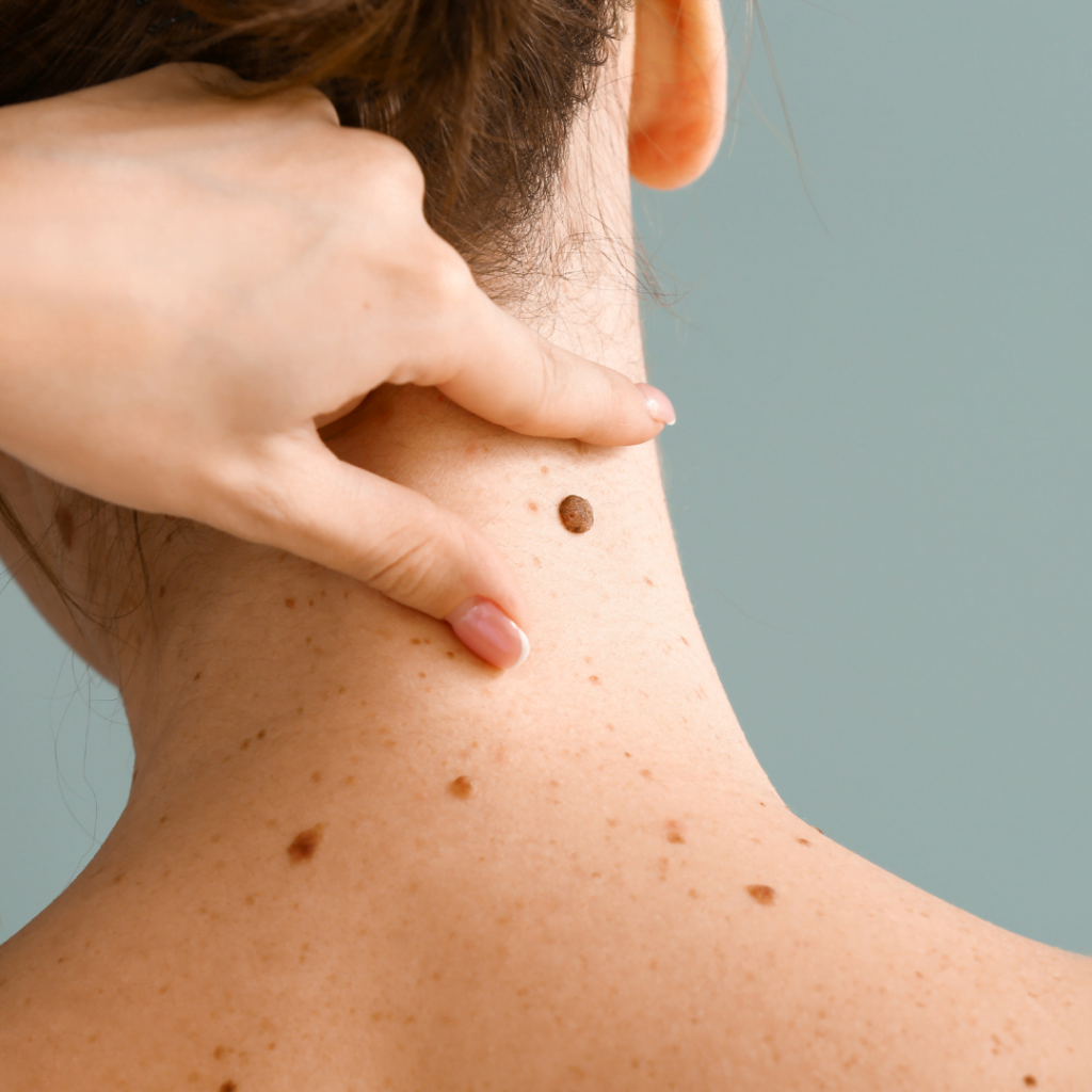 preporuku za uklanjanje fibroma lekar daje ako su na nezgodnim mestima. na slici dermatolog pokazuje na fibrom na vratu pacijenta koji je potrebno ukloniti