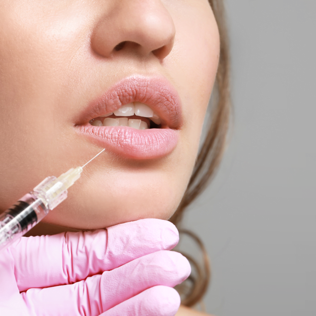 aplikacija hijaluronskih filera u ženske usne