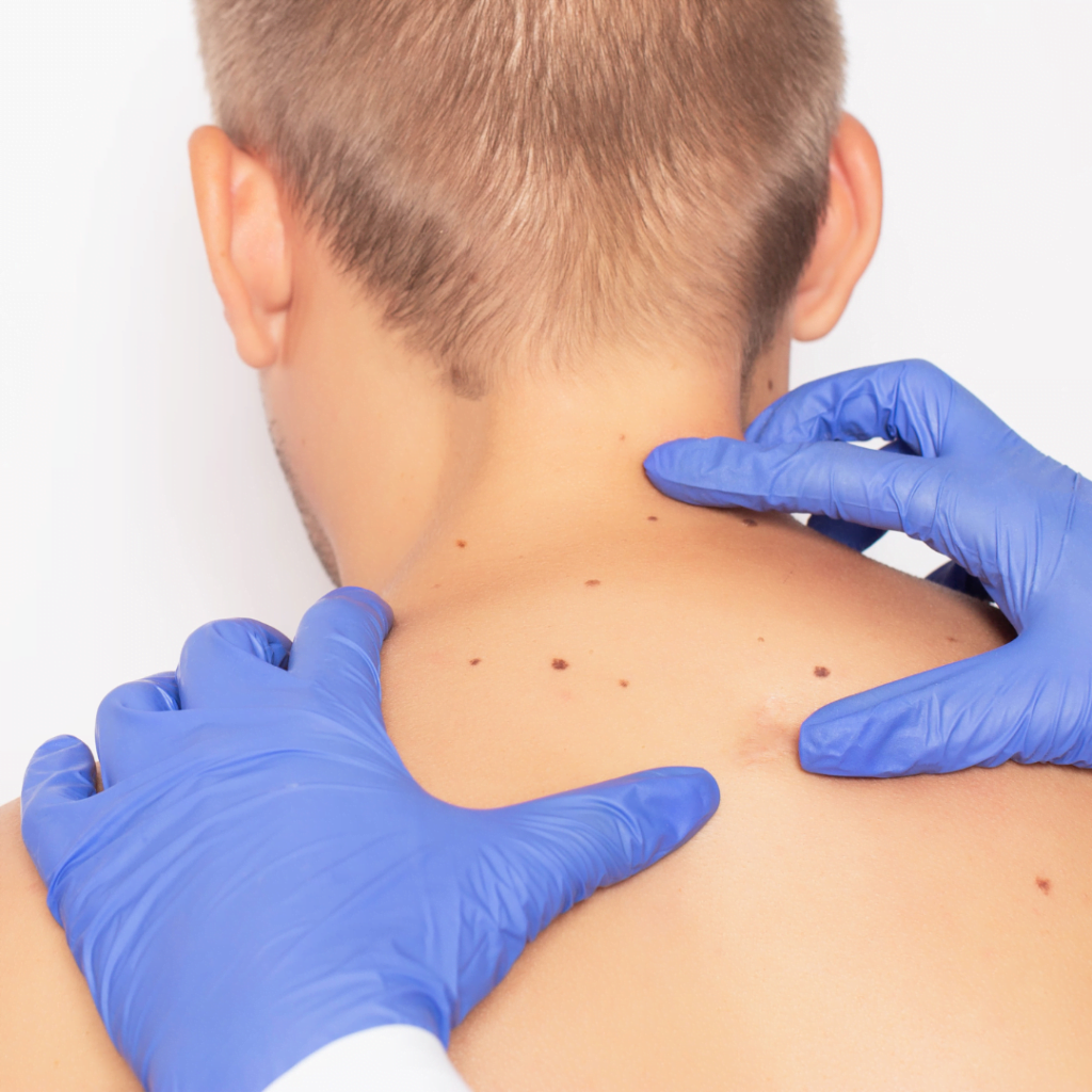 priprema za uklanjanje fibroma: dermatolog detaljno pregleda fibrome na leđima pacijenta pre uklanjanja