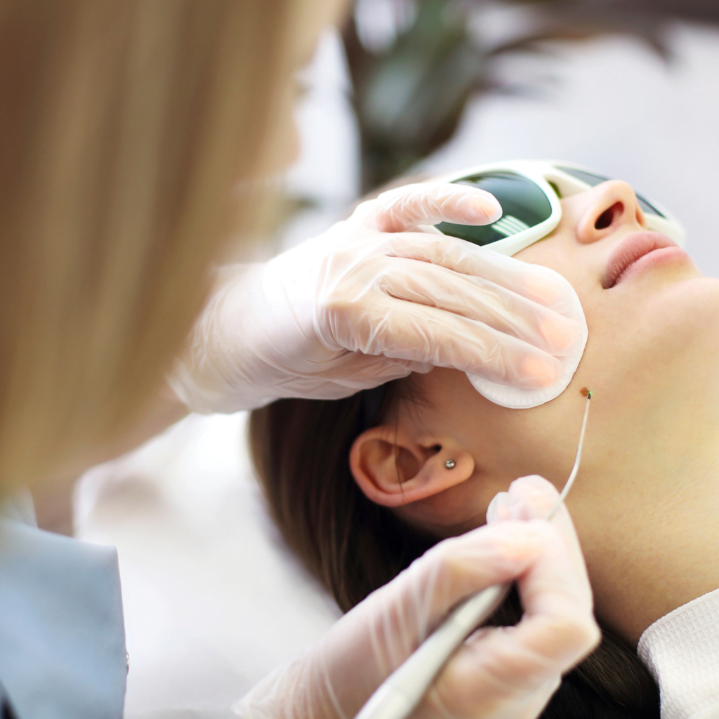 žena leži na stolu a plavokosa dermatološkinja joj uklanja bradavicu sa lica