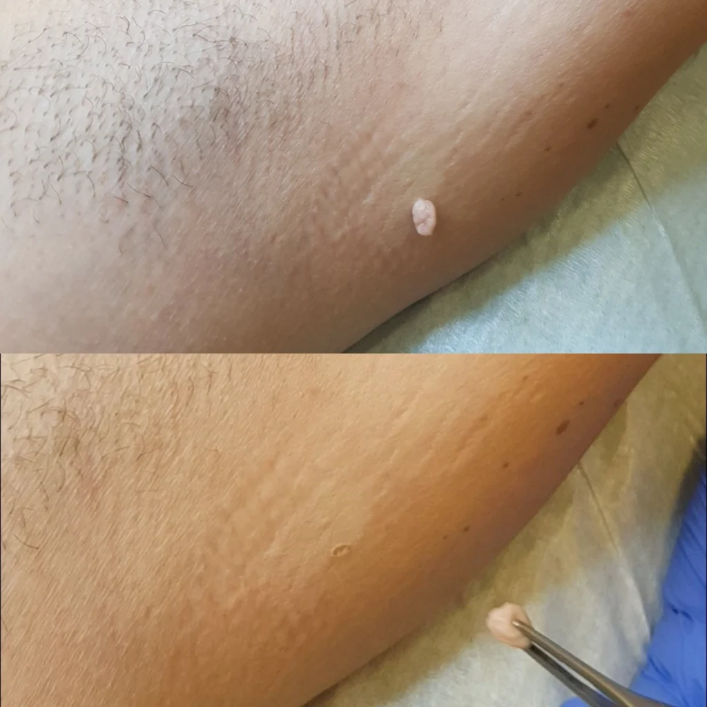 Uklanjanje fibroma | Diva Laser Centar & Klinika