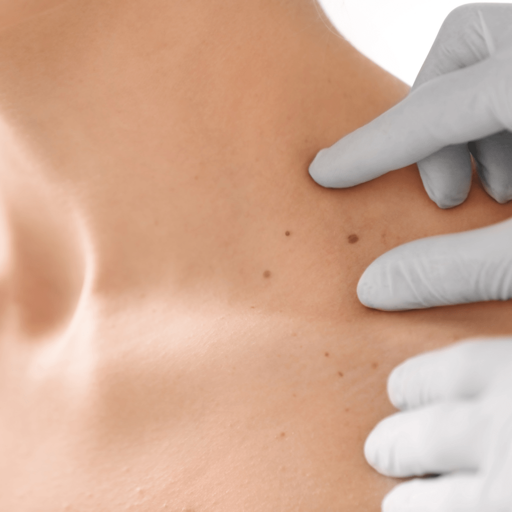 benigne promene na koži: mladež