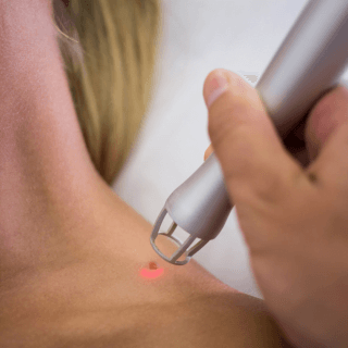 laser iznad mladeža na ramenu plavokose žene - prikazano je uklanjanje mladeža radiotalasima u dermatološkoj ordinaciji diva medical