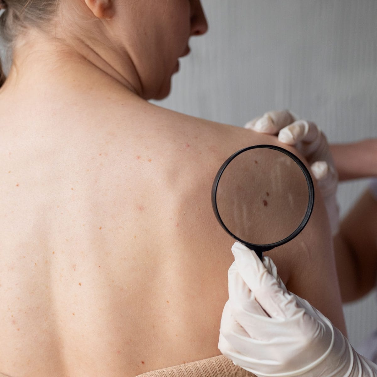 mladež na leđima pod lupom tokom dermatološkog pregleda u dermatološkoj ordinaciji diva medical u beogradu