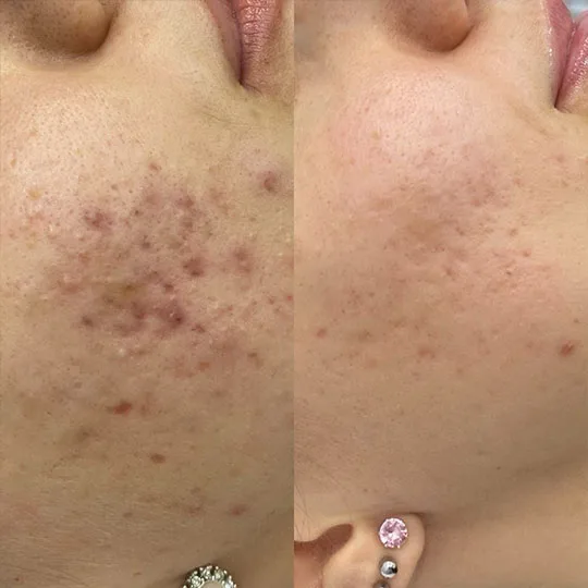lecenje-akni-i-oziljaka-od-akni_laserske-procedure.jpg