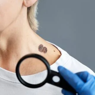 pregled mladeža dermatoskopom u dermatološkoj ordinaciji diva medical