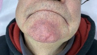 muška brada nakon uklanjanja kapilara