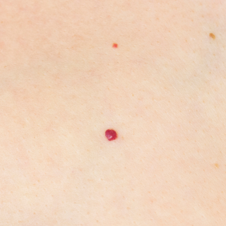 crveni angiom na koži