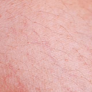 prošireni kapilari na koži