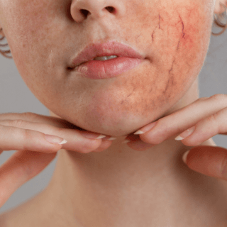 donji deo ženskog lica na kome je vidljivo crvenilo zbog proširenih kapilara