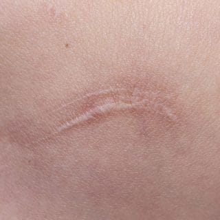 keloidni ožiljak na koži