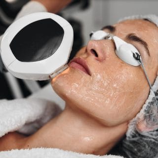lasersko lečenje rozacee u dermatološkoj ordinaciji u beogradu