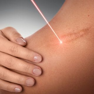 lasersko uklanjanje ožiljaka u dermatološkoj ordinaciji