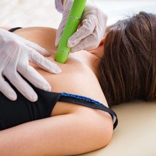 žena leži na stomaku, a dermatolog drži laser iznad ožiljka na njenim leđima - u toku je lasersko uklanjanje ožiljaka u dermatološkoj ordinaciji