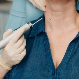 lasersko uklanjanje ožiljaka sa vrata: vrat žena u tirkiznoj košulji iznad koga ruka dermatologa u beloj rukavici drži laser