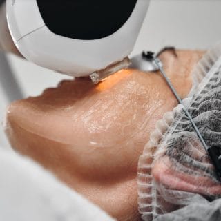 laser na ženskom obrazu - lasersko lečenje rozacee