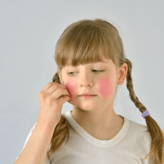dermatološki pregled deteta neophodno je obaviti na pojavu prvih simptoma, poput crvenila na obrazima koje ima smeđokosa devojčica sa kikicama na slici