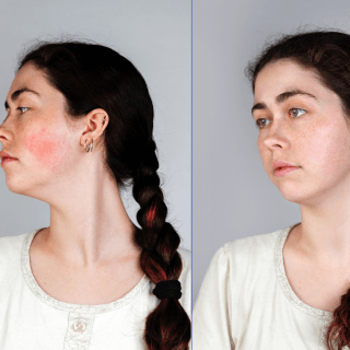 lasersko lečenje kuperoze: fotografija crnokose žene sa kosom vezanom u kiku, pre i posle lečenja