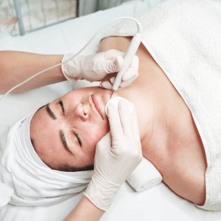 lasersko lečenje kuperoze u dermatološkoj ordinaciji - žena leži zatvorenih očiju na medicinskom stolu, dok dermatolog u belim rukavicama izvodi tretman laserskog lečenja kuperoze na njenom licu