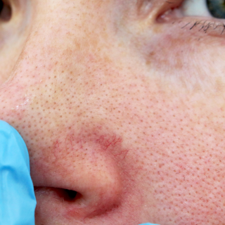 prikaz dela lica i nosa osobe koja ima kuperozu