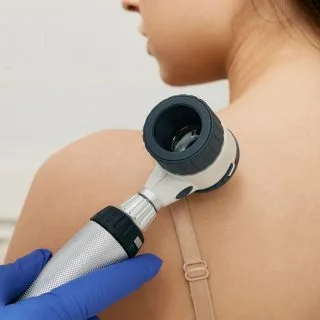 dermoskopija kao prevencija ozbiljnih kožnih bolesti - ruka dermatologa u plavoj rukavici drži dermoskop na leđima pacijentkinje