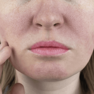 slika donjeg dela ženskog lica na kome je vidljivo crvenilo zbog prisutne kuperoze