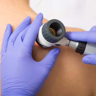 dermatolog u ljubičastim rukavicama držim dermatoskop i pregčeda keratoze na koži pacijenta