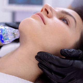 lifting lica radiofrekventnom energijom - žena leži, a ruka dermatologa drži laser na njenoj bradi - u toku je rf zatezanje kože lica