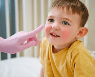 dečak u žutoj majici sa crvenilom na licu sedi na krevetu a pored njegovog lica se nalazi šaka dečijeg dermatologa kod koga je došao na pregled