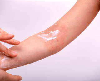 ruka crvena na pregibu lakta, na crvenilu je krema, a dečiji dermatolog, čija je šaka prikazana pregleda kožu