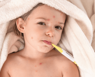 dečak sa boginjama na licu i toplomerom u ustima leži na peškiru