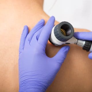 pregled kože na leđima dermoskopom - ruka dermatologa u ljubičastim rukavicama drži dermoskop iznad leđa pacijenta - dermatološki pregled u toku