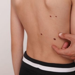 dermatološki pregled mladeža na muškim leđima