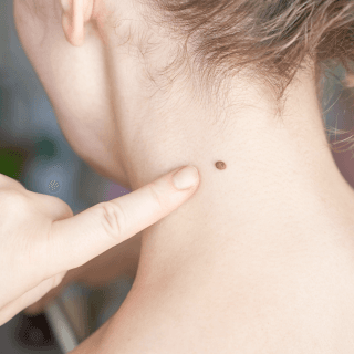 dermatolog prstom pokazuje fibrom na vratu žene