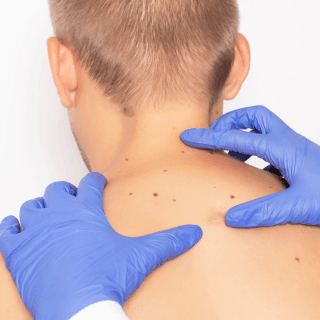 lasersko uklanjanje fibroma bezbedno je i decu; na slici je plavokosi dečak sa fibromima na leđima na dermatološkom pregledu