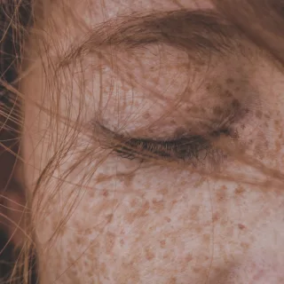 deo lica riđokose žene na kome su vidljive fleke. ukoliko vaš dermatolog to odobri, lasersko uklanjanje fleka je efikasno rešenje.