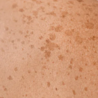 fleke na koži. Ako razmišljate da li je lasersko uklanjanje fleka rešenje za vas, konsultujte se sa svojim dermatologom.