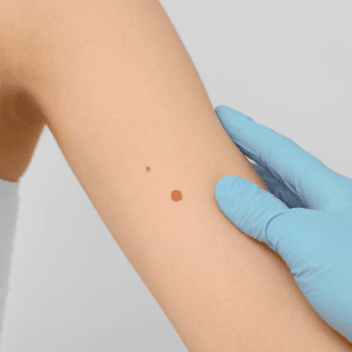 pregled mladeža na ruci - uklanjanje mladeža važno je naročito kada su nezgodno pozicionirani pa su izloženi trenju odeće i mogućim povredama