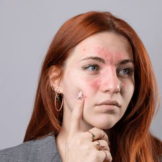 riđokosa žena drži prst na licu na kome je izraženo crvenilo, što je jedan od najizraženijih simptoma rozacee