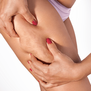 ženske ruke drže celulit na nozi