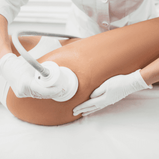 laserska lipoliza zadnjice u dermatološkoj ordinaciji