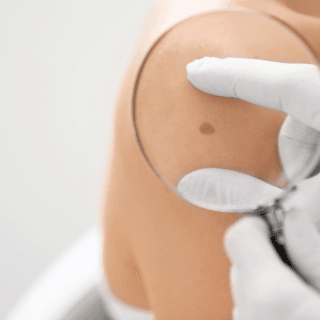 dermatolog detaljno pregleda mladež na ramenu žene pod lupom, nakon čega će joj saopštiti da li je vreme za uklanjanje mladeža