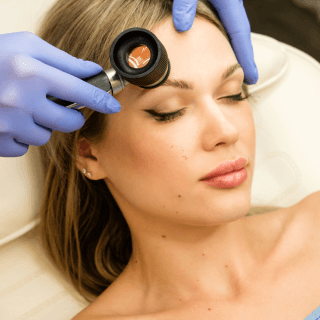 žena leži na stolu u dermatološkoj ordinaciji, a vide se i ruke dermatologa koje drže dermoskop kojim se pregleda mladež na njenom čelu jer je ovaj vid pregleda neophodan pre nego što se odlučite za uklanjanje mladeža